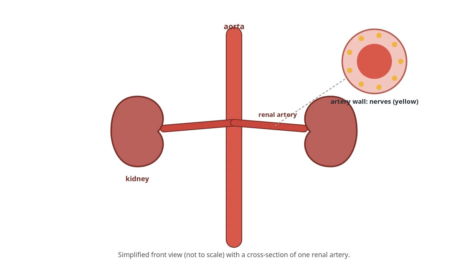 Renal denervation for high blood pressure: a Cath Lab 101 guide