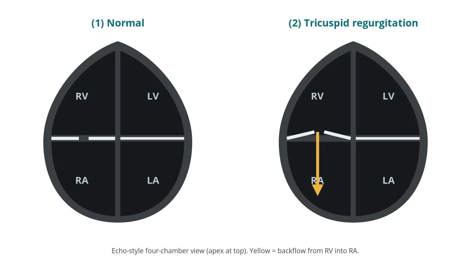 Transcatheter tricuspid valve implantation (TTVI): a Cath Lab 101 guide