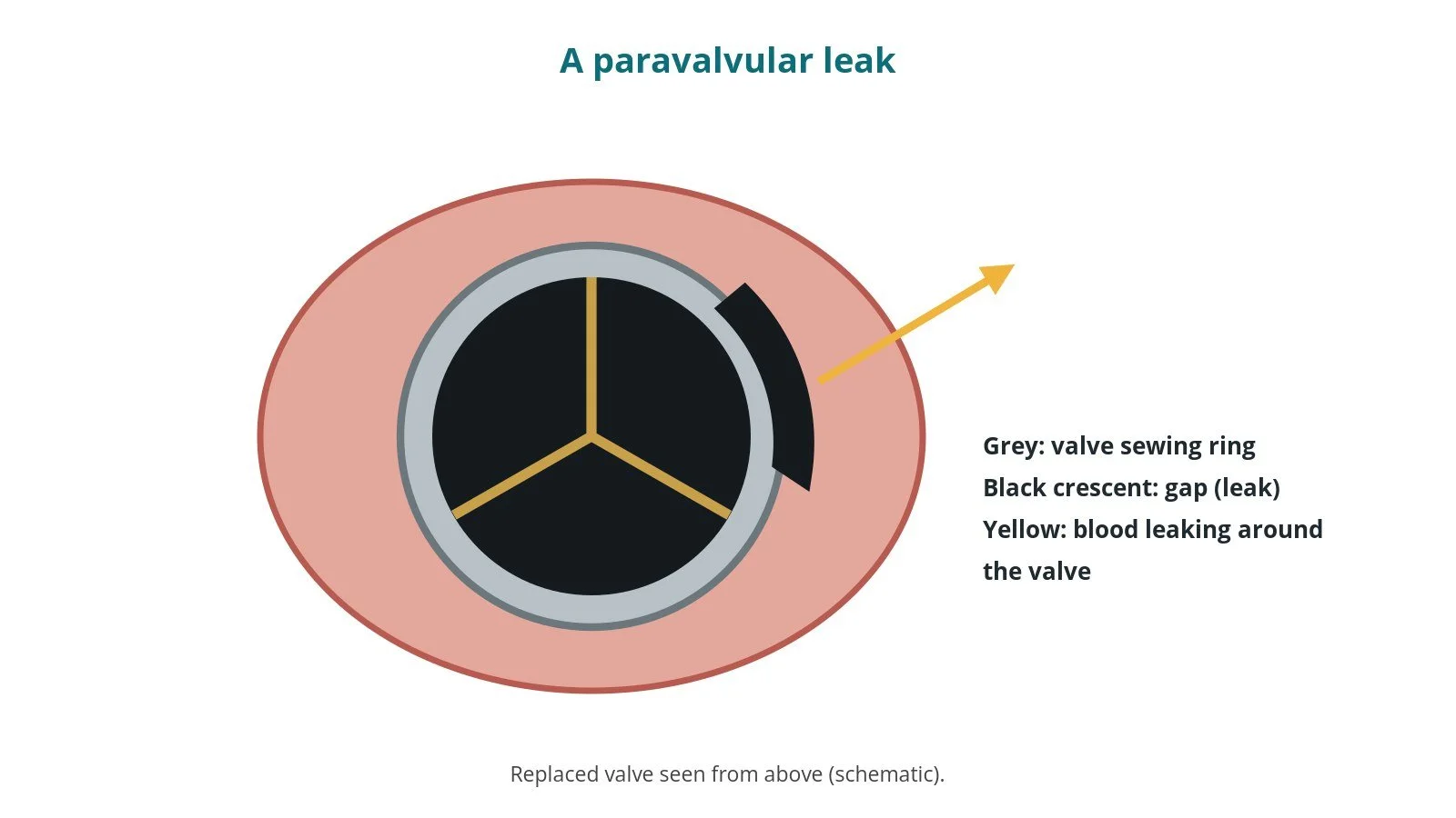 Paravalvular leak (PVL) closure: a Cath Lab 101 guide