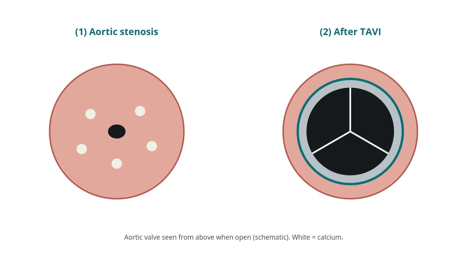 Transcaval TAVI (caval-aortic access): a Cath Lab 101 guide