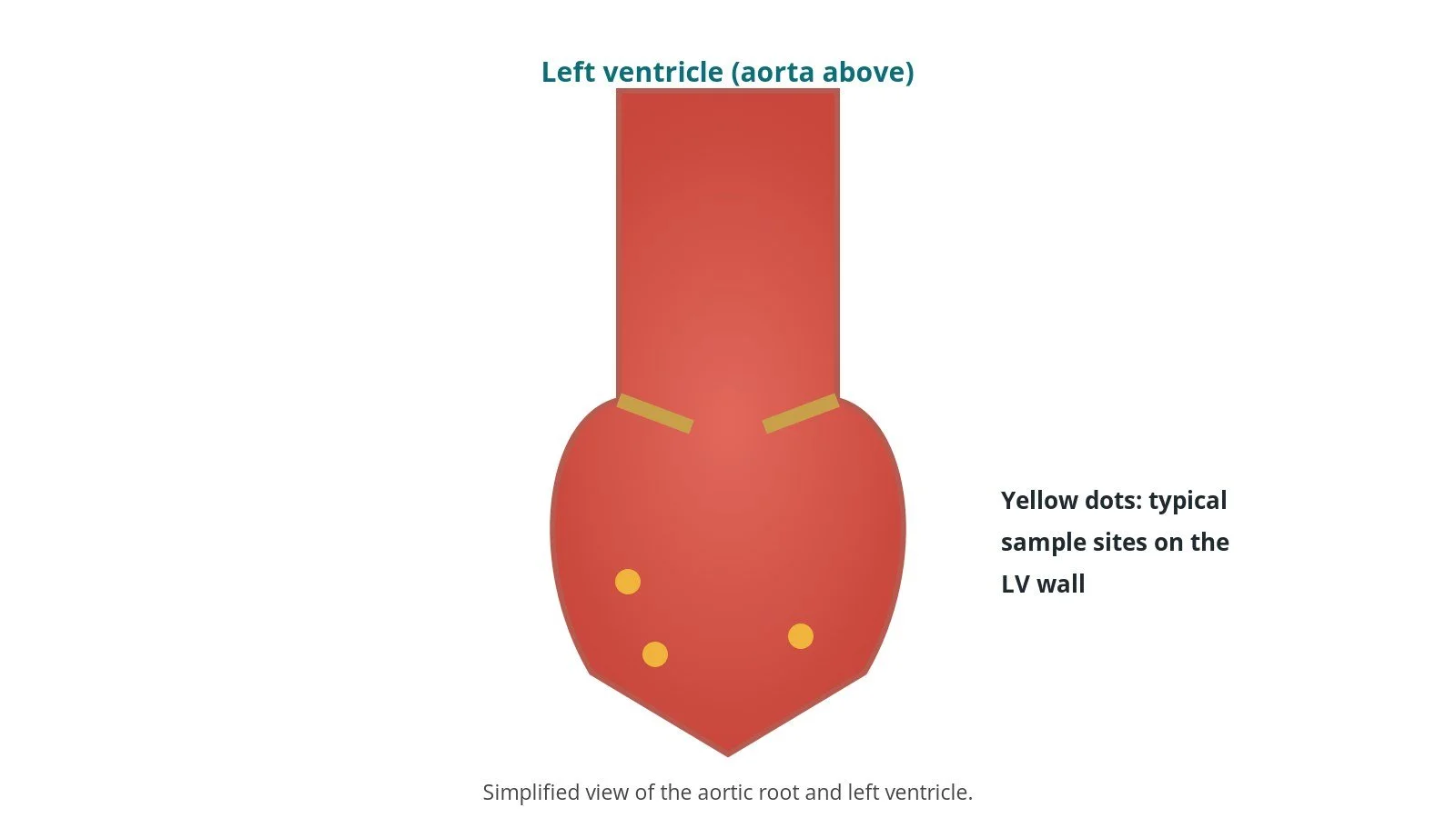 Left ventricular (endomyocardial) biopsy: a Cath Lab 101 guide