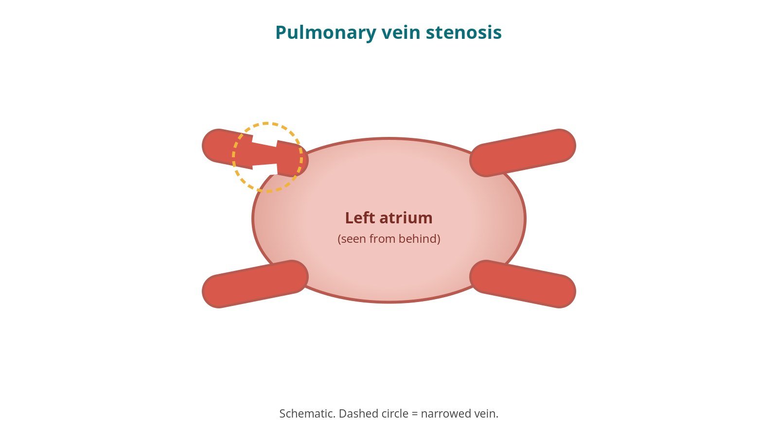 Pulmonary vein venoplasty and stenting: a Cath Lab 101 guide
