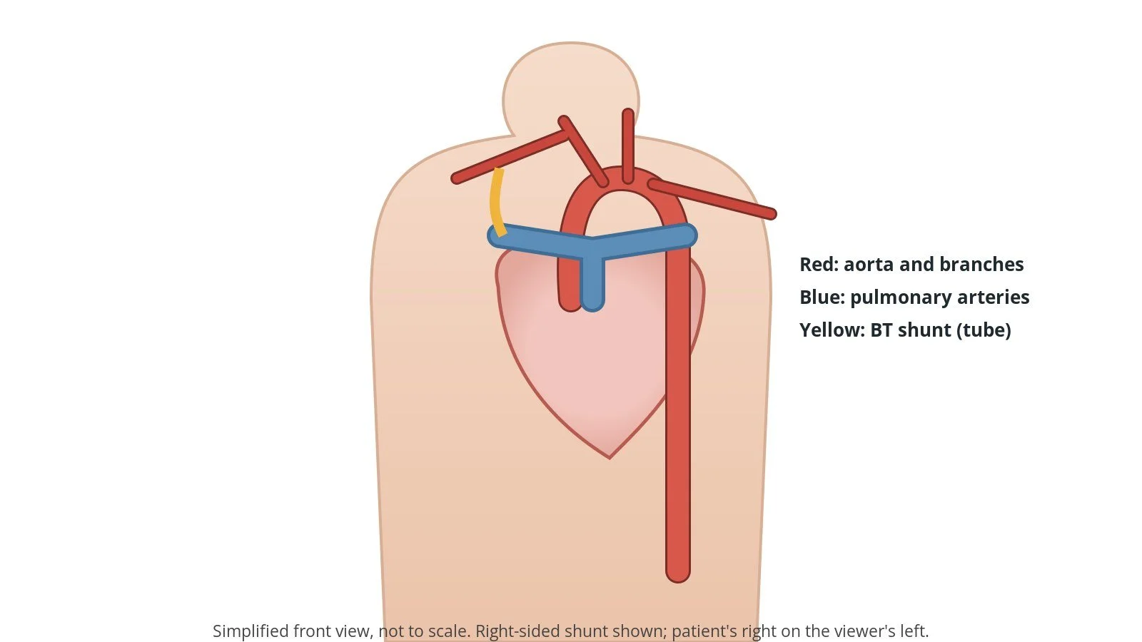 BT shunt closure and pulmonary artery stenting: a Cath Lab 101 guide