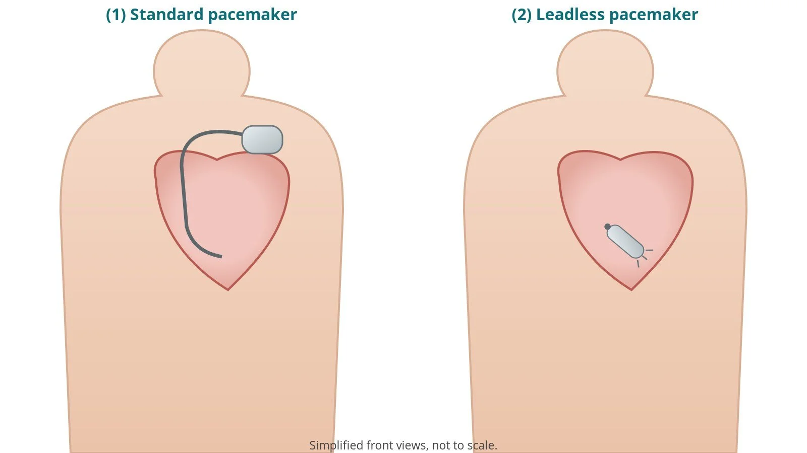 Leadless pacemaker retrieval (extraction): a Cath Lab 101 guide
