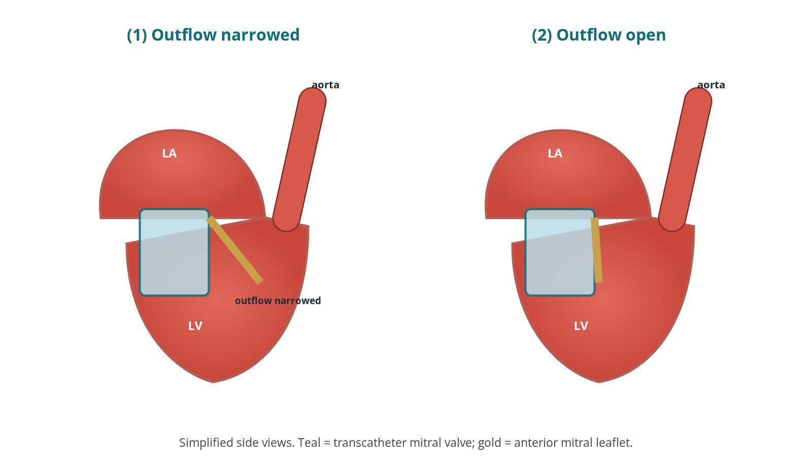 LAMPOON (mitral leaflet laceration before TMVR): a Cath Lab 101 guide