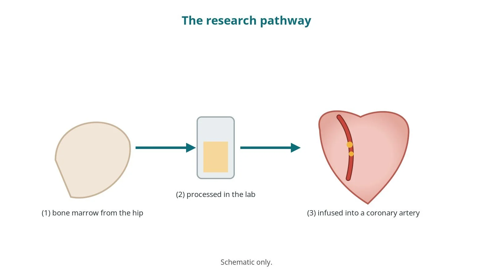 Intracoronary cell infusion (research procedure): a Cath Lab 101 guide