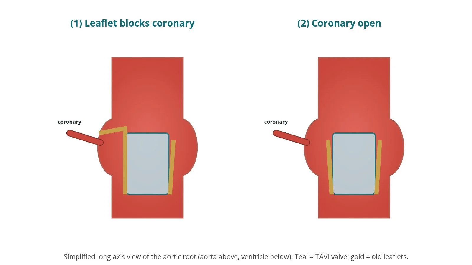 LLAMACORN (balloon leaflet laceration before TAVI): a Cath Lab 101 guide