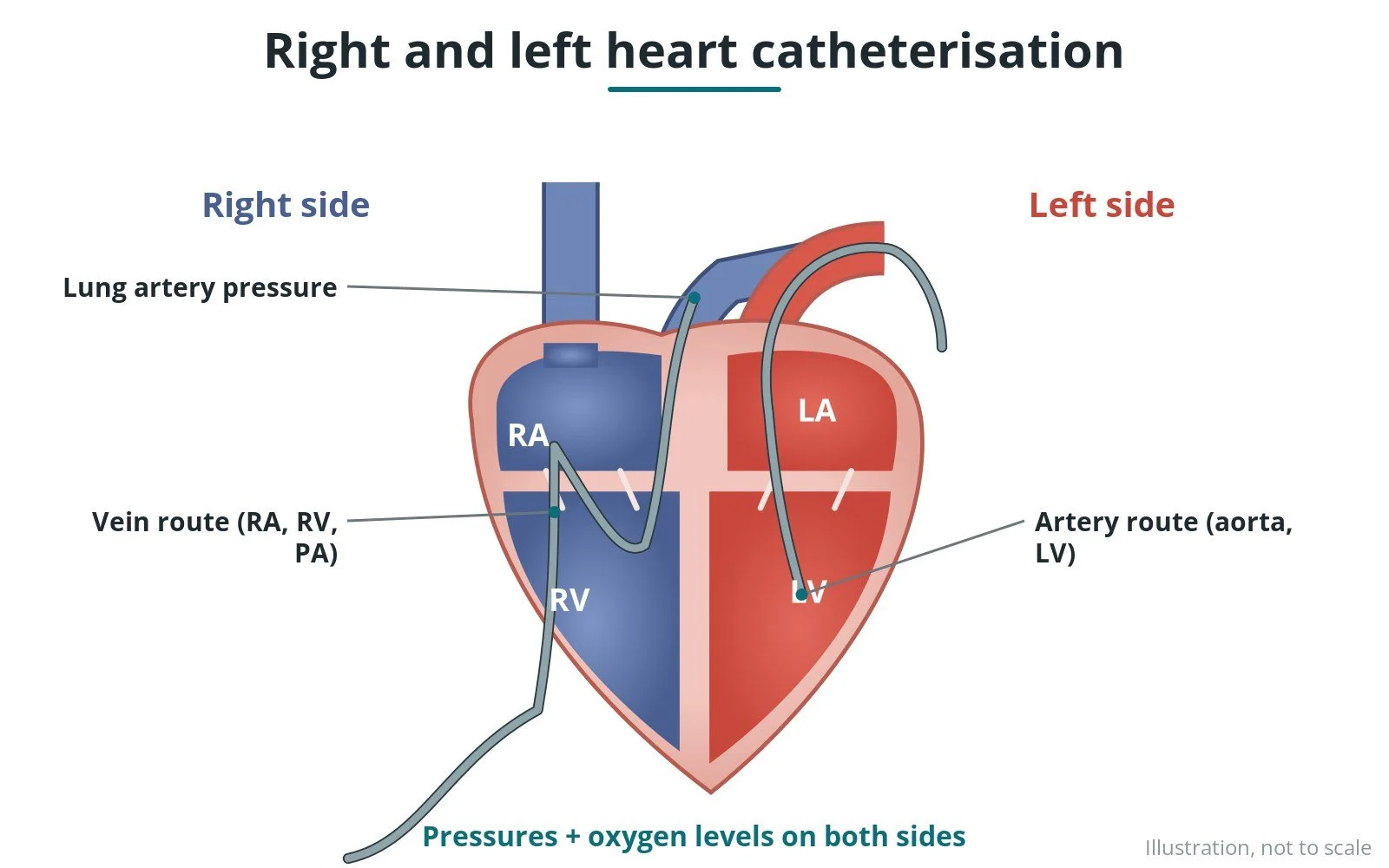 Right and left heart catheterisation: a Cath Lab 101 guide