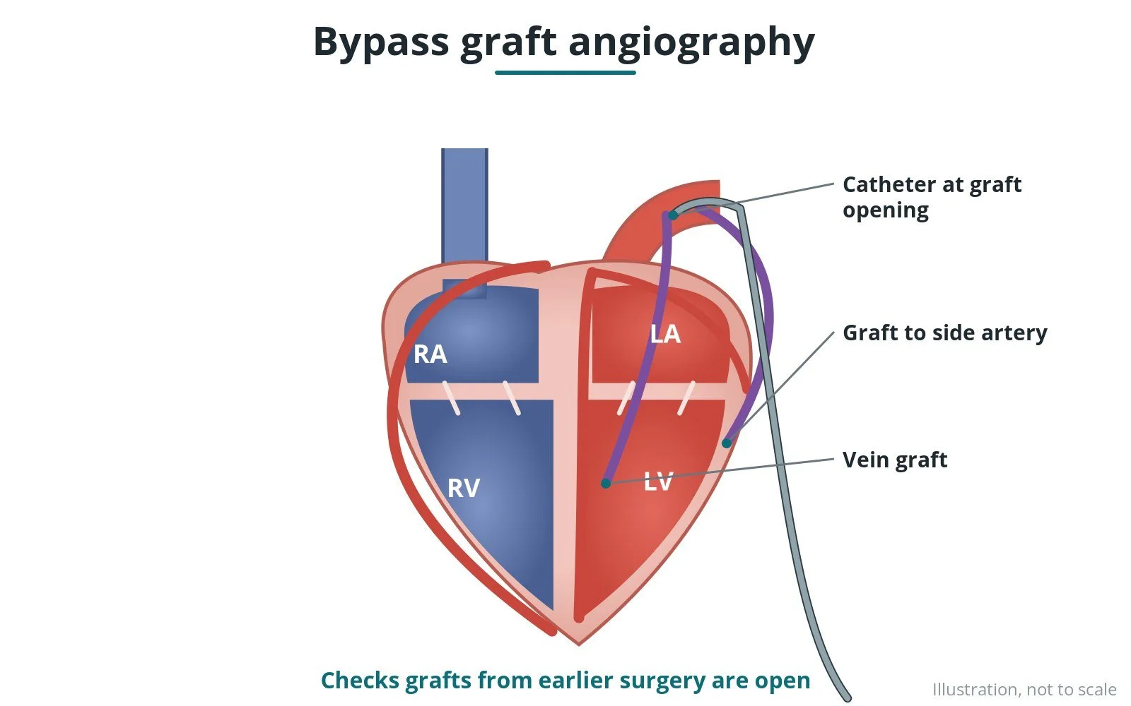 Bypass graft angiography: a Cath Lab 101 guide
