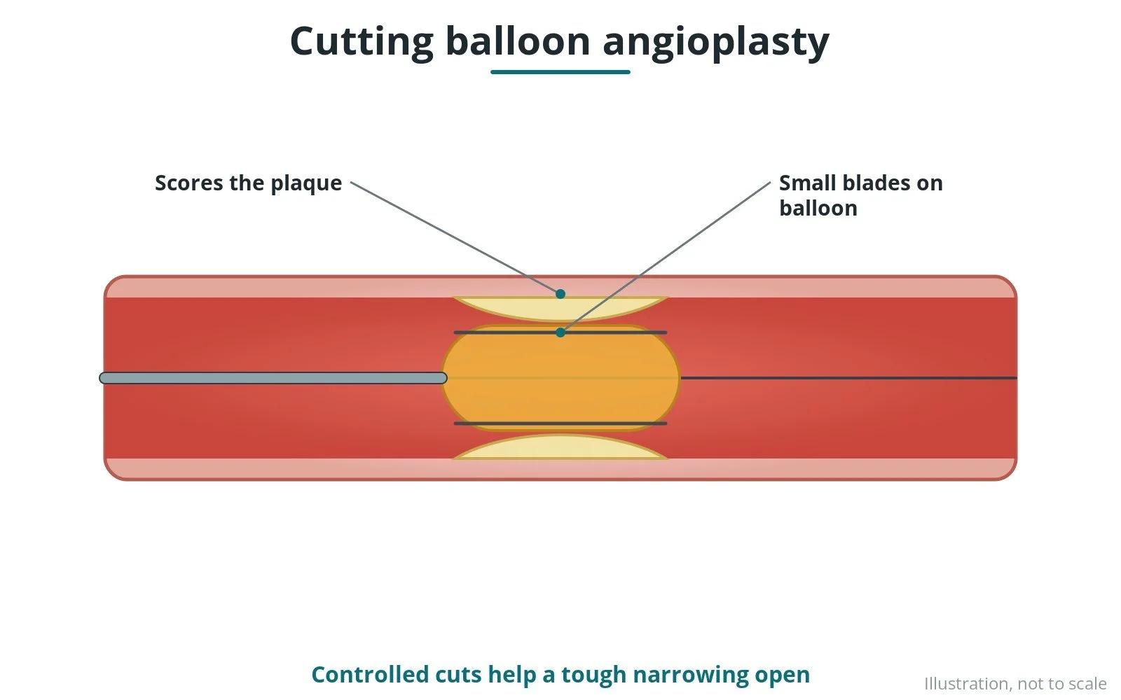 Cutting and scoring balloon angioplasty: a Cath Lab 101 guide