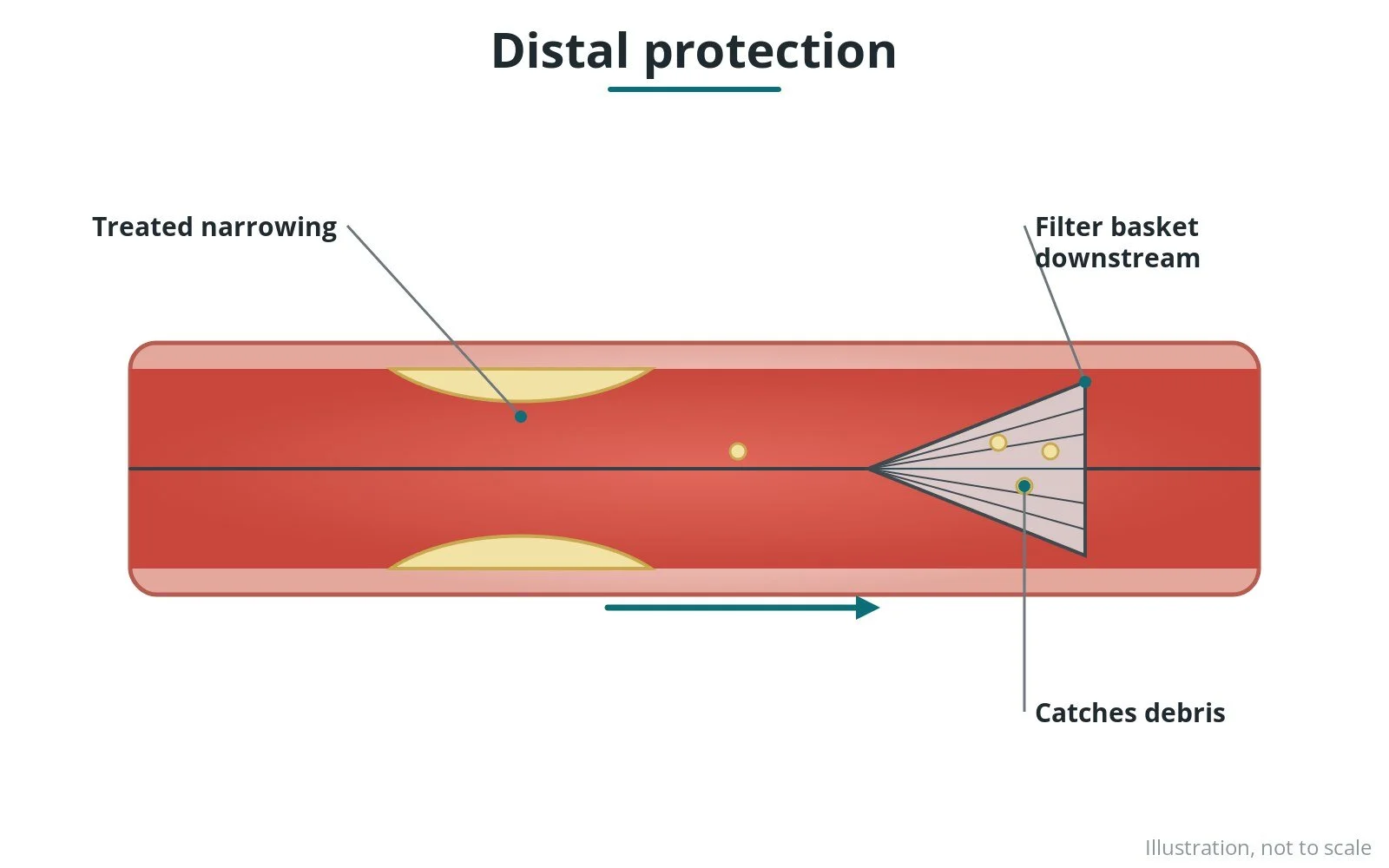 Distal embolic protection: a Cath Lab 101 guide