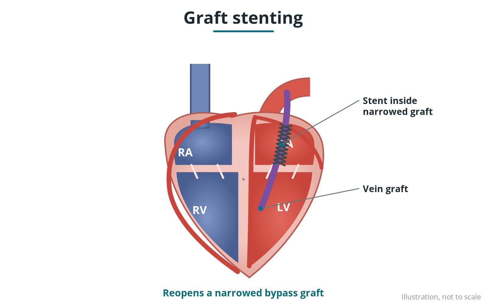 Bypass graft stenting: a Cath Lab 101 guide