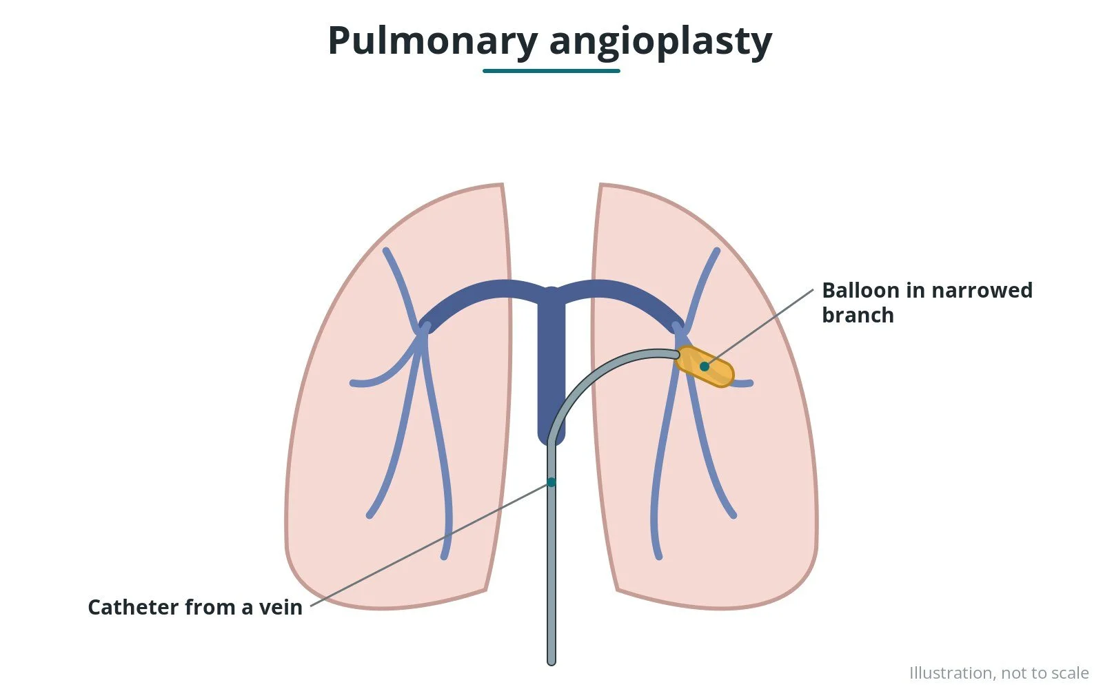 Pulmonary artery balloon angioplasty: a Cath Lab 101 guide