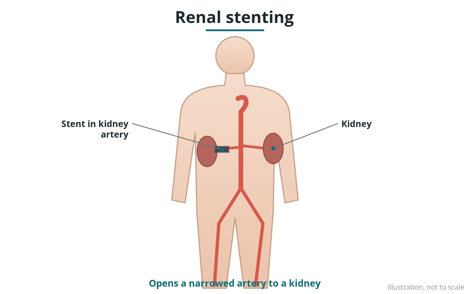 Renal artery stenting: a Cath Lab 101 guide
