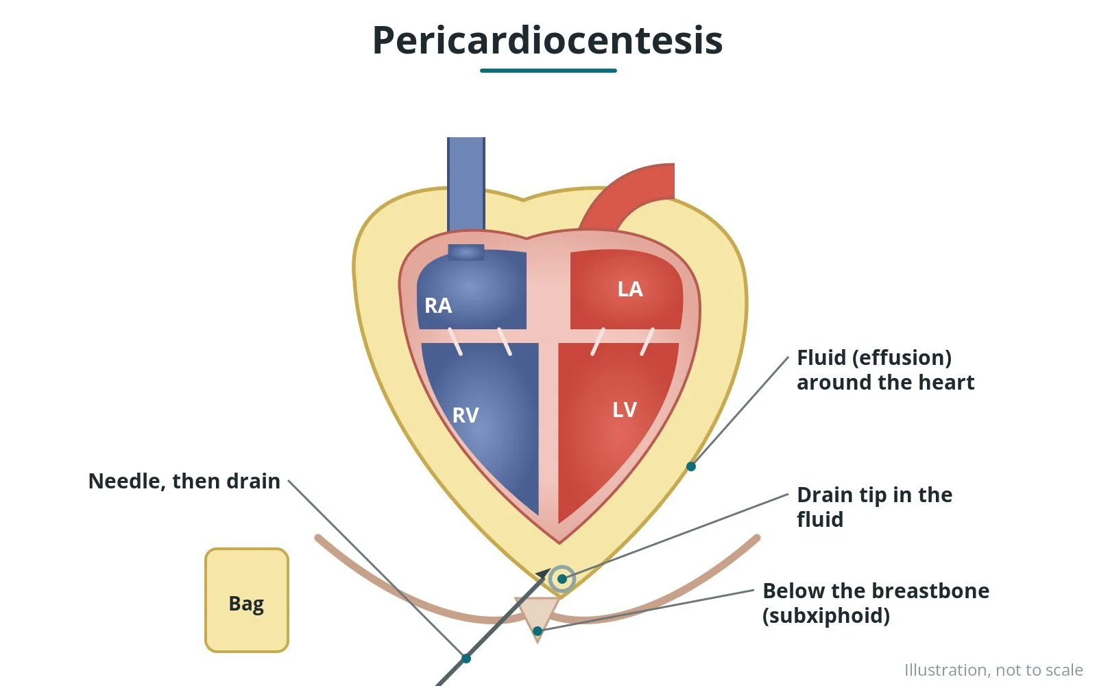 Pericardiocentesis: a Cath Lab 101 guide