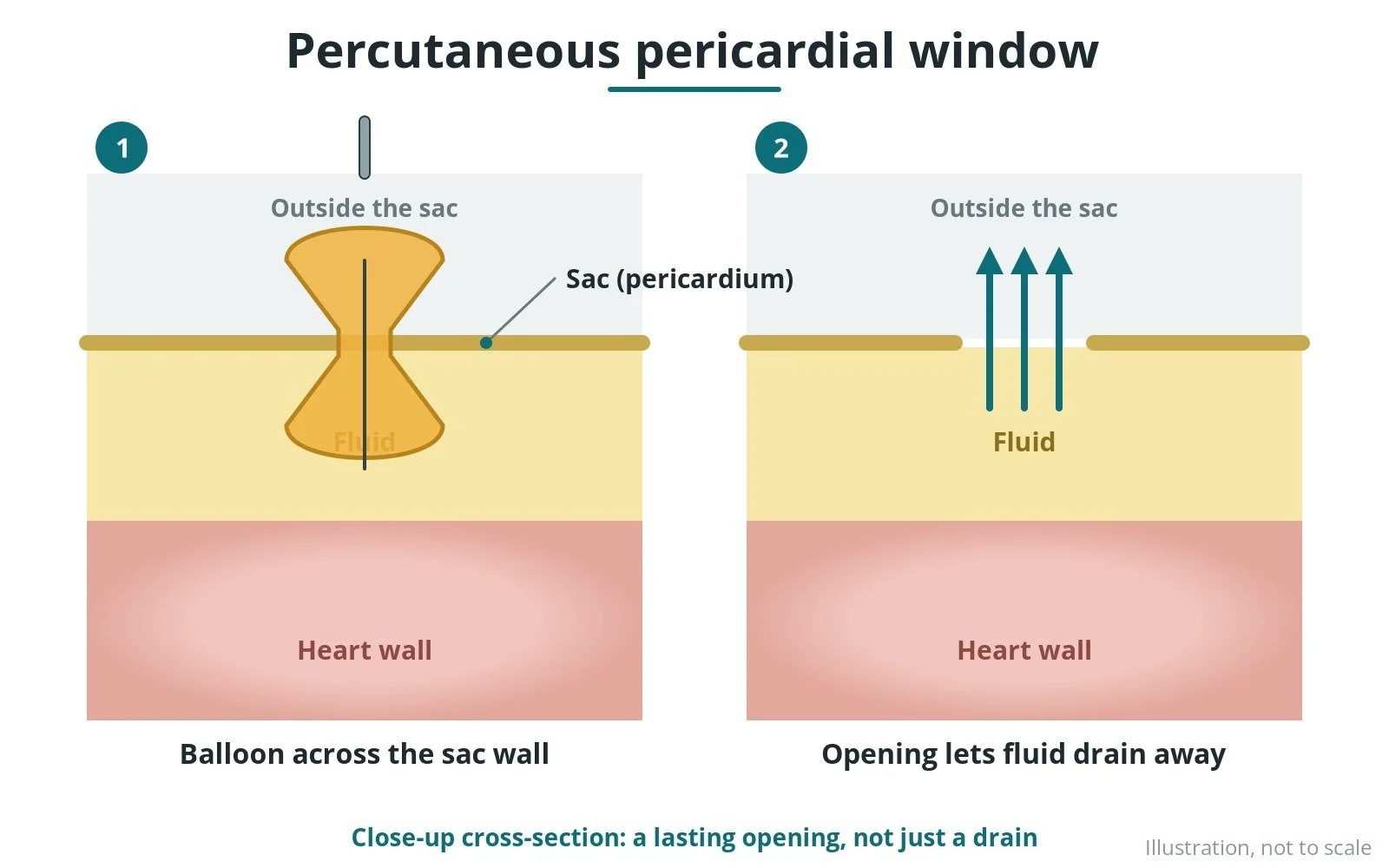 Percutaneous pericardial window (balloon pericardiotomy): a Cath Lab 101 guide