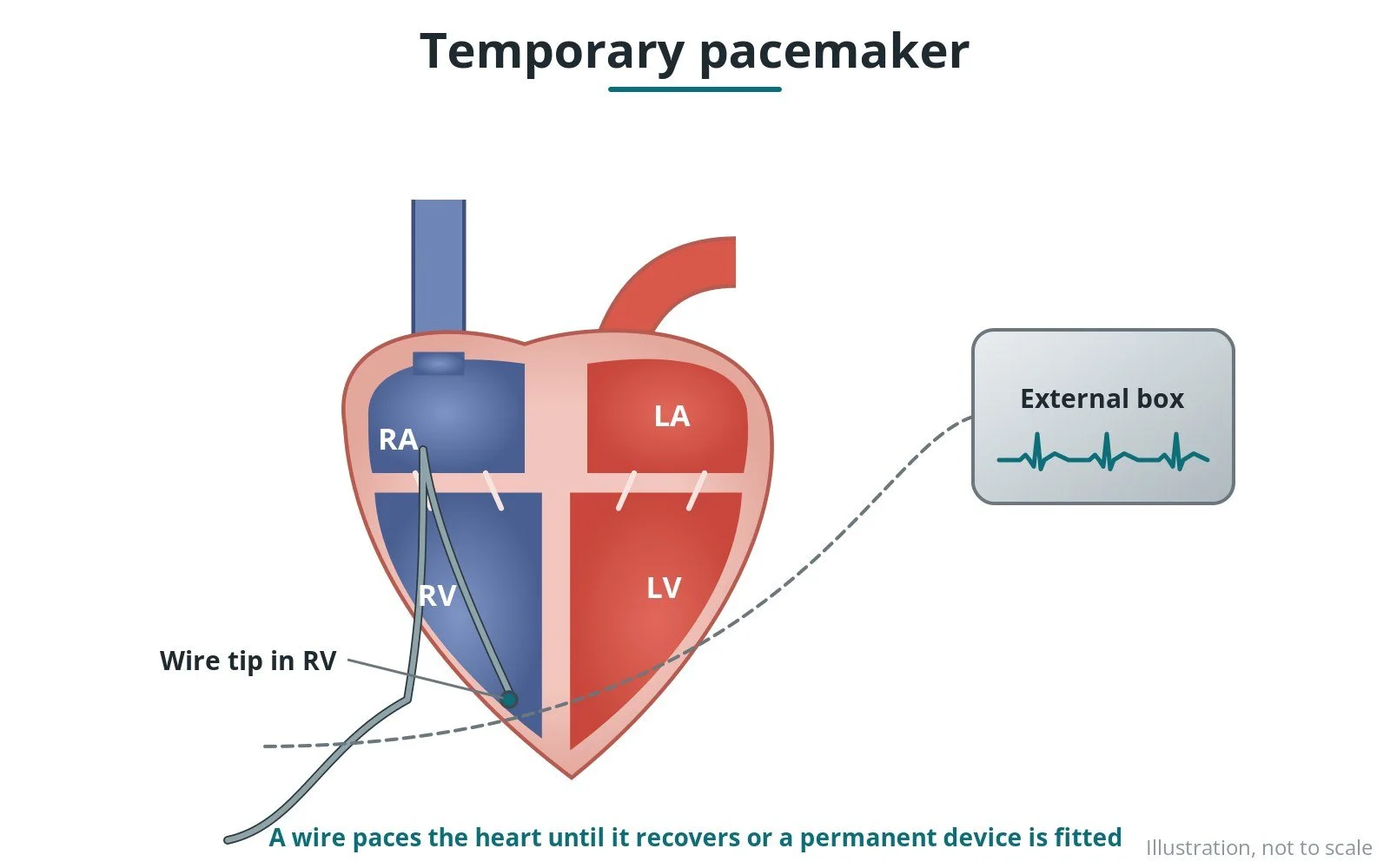 Temporary pacing wire insertion: a Cath Lab 101 guide