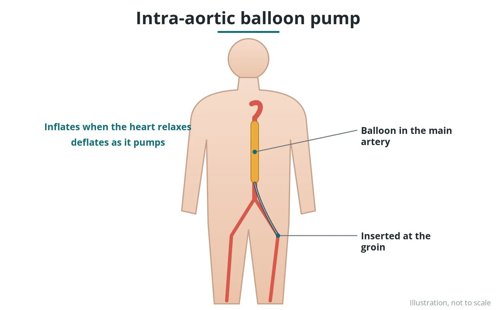 Intra-aortic balloon pump (IABP): a Cath Lab 101 guide