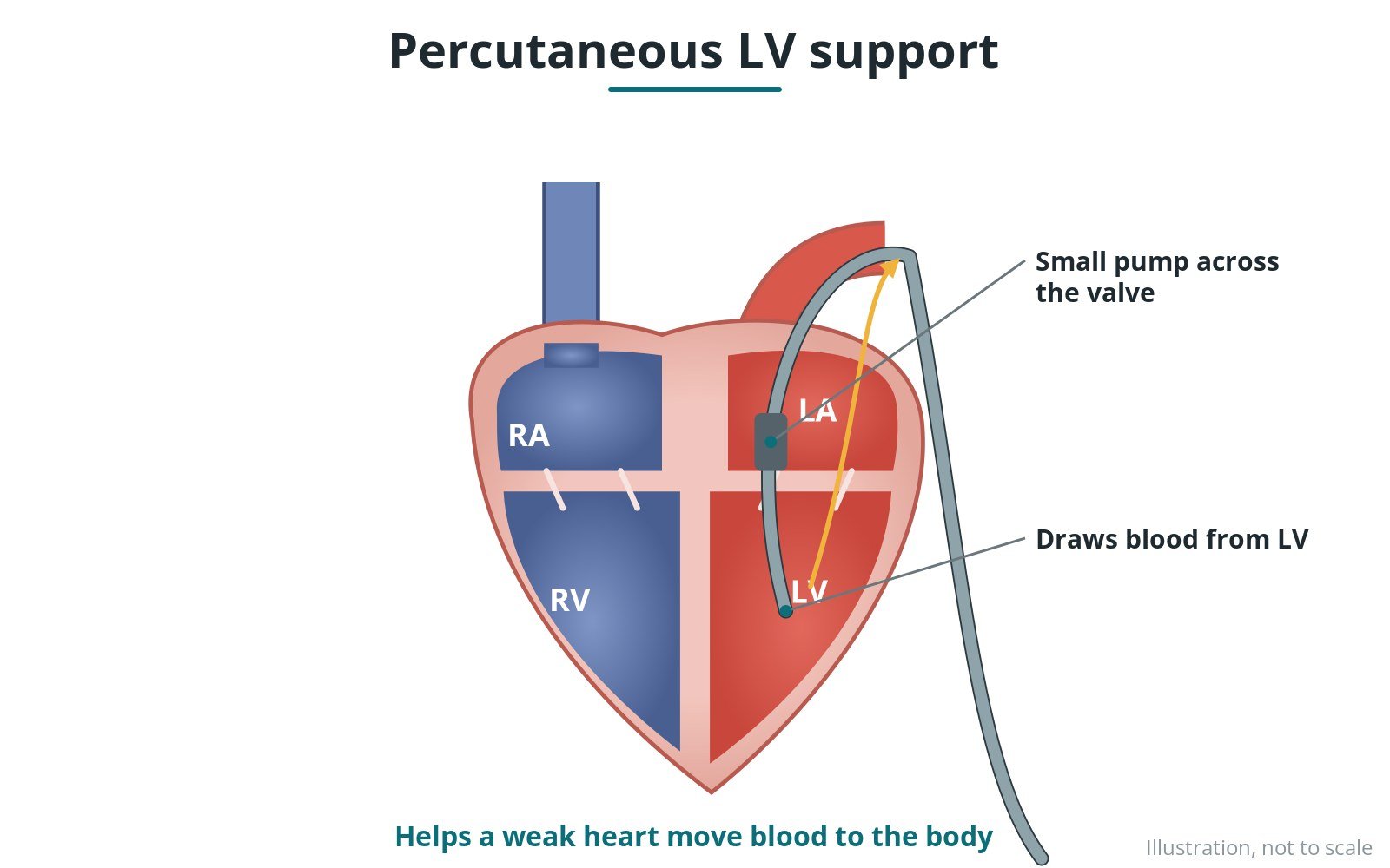Percutaneous LV support devices: a Cath Lab 101 guide