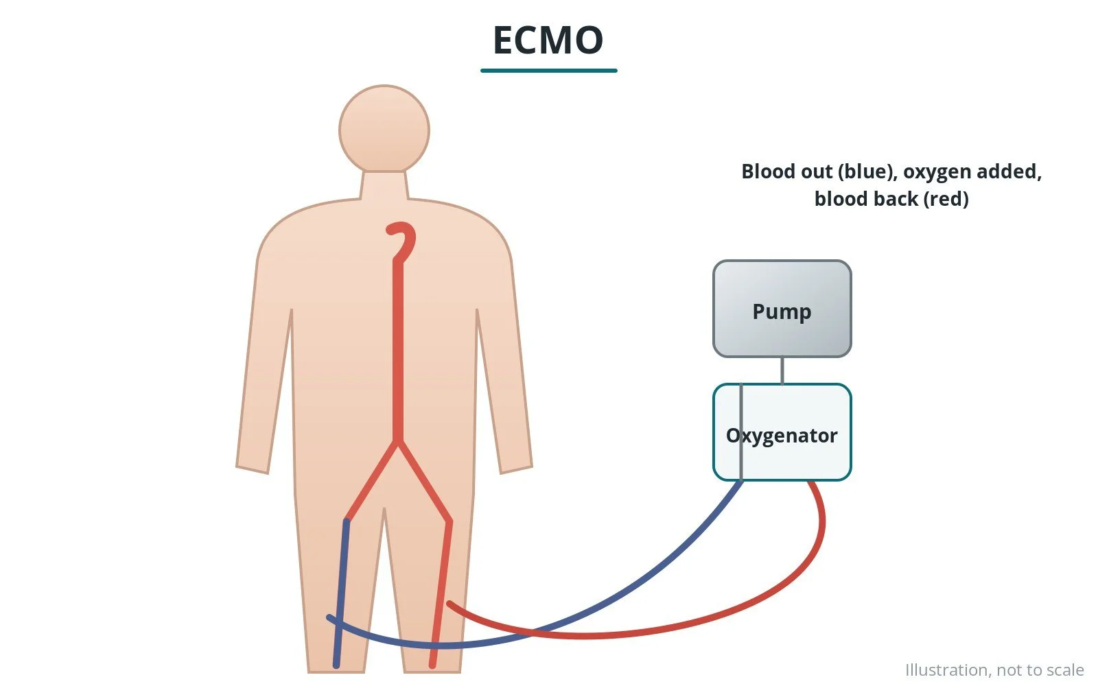ECMO (extracorporeal membrane oxygenation): a Cath Lab 101 guide