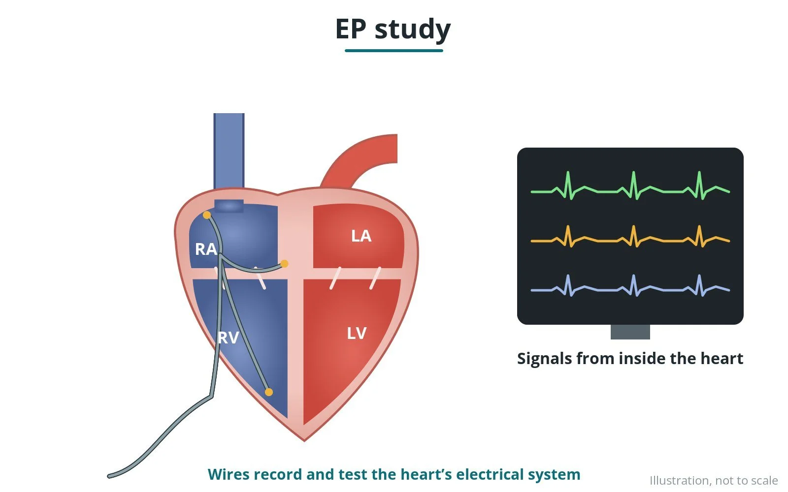 Electrophysiology (EP) study: a Cath Lab 101 guide