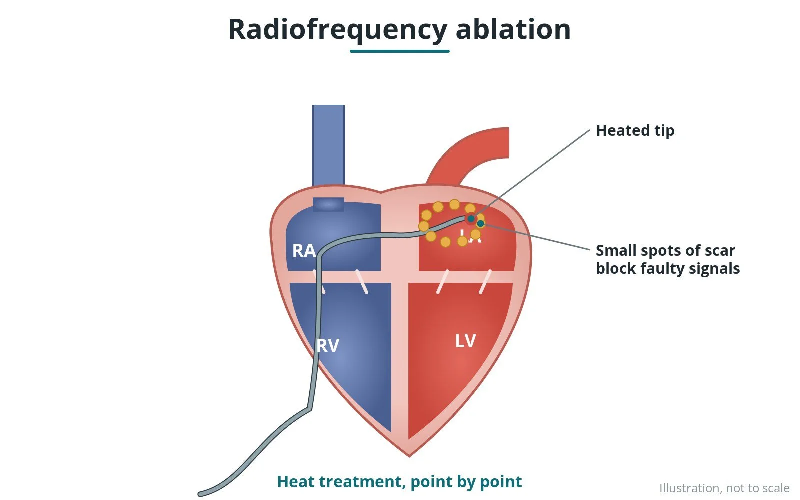 Radiofrequency (RF) ablation: a Cath Lab 101 guide