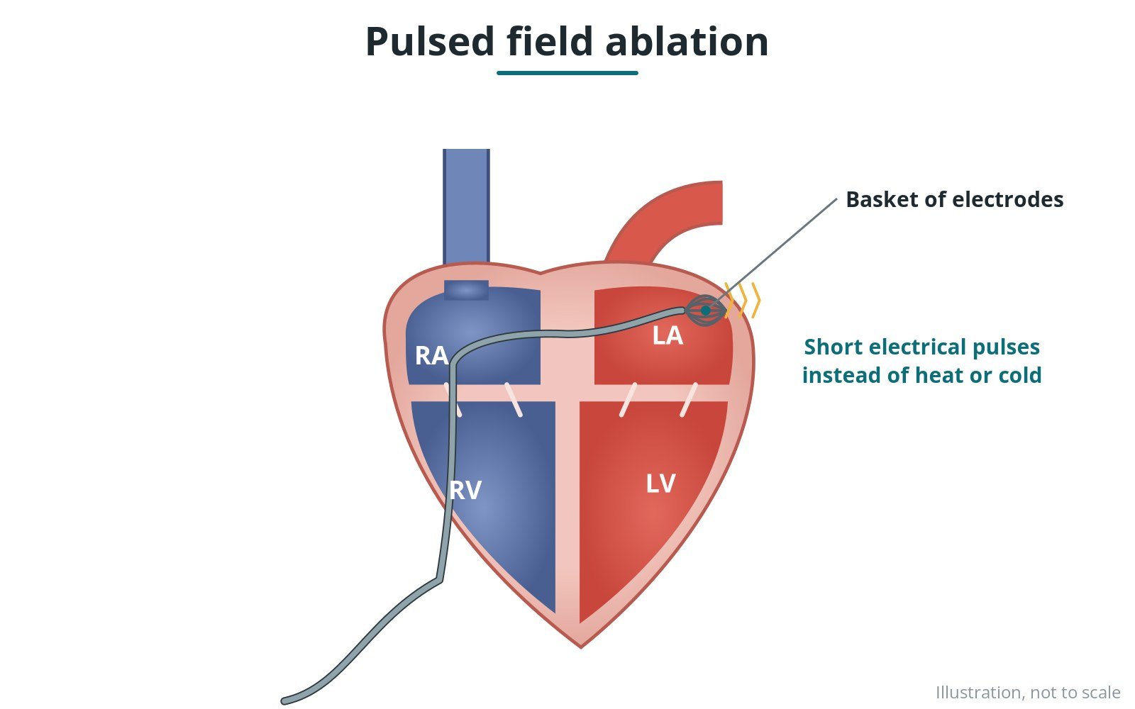 Pulsed field ablation (PFA): a Cath Lab 101 guide