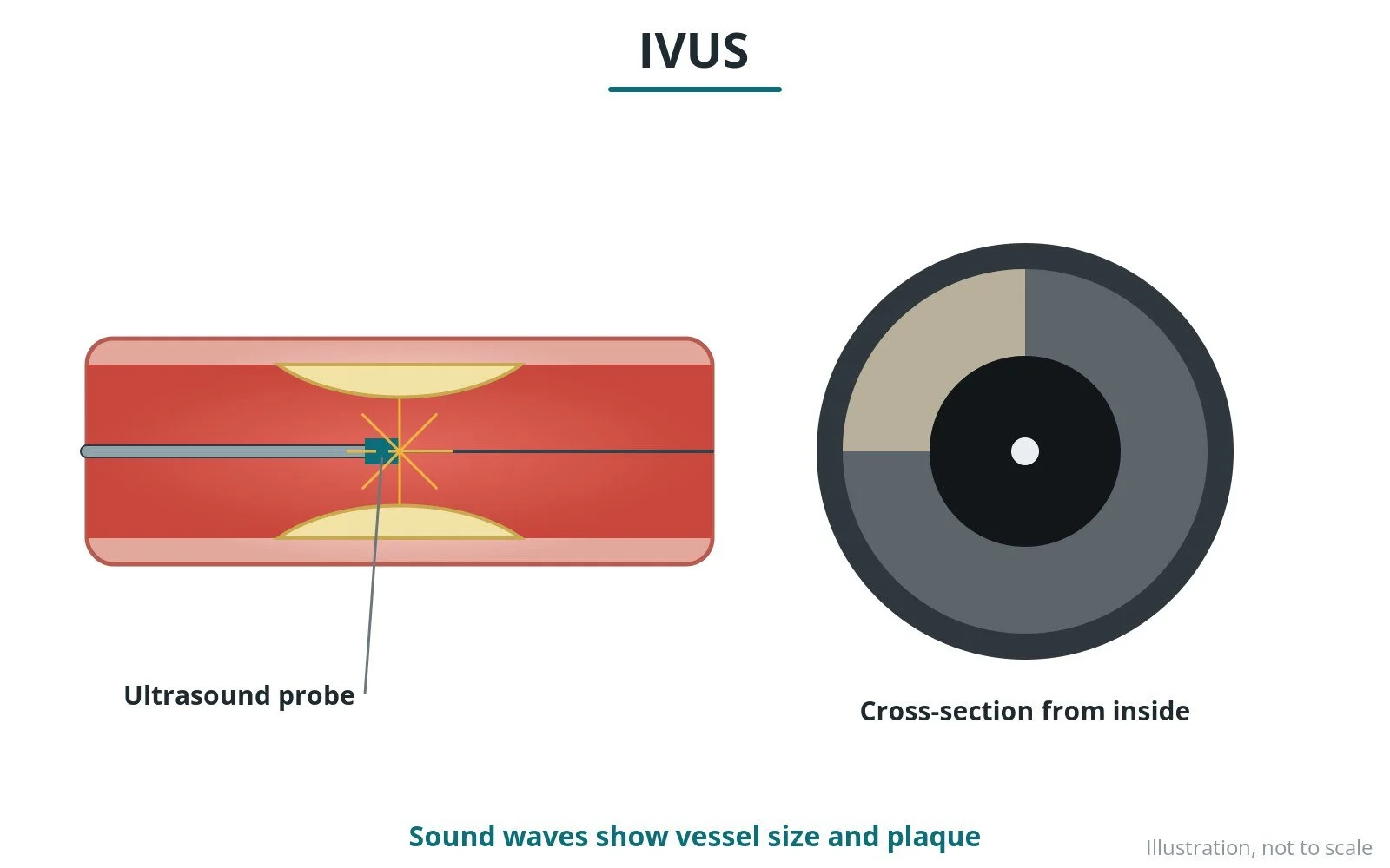 Intravascular ultrasound (IVUS): a Cath Lab 101 guide