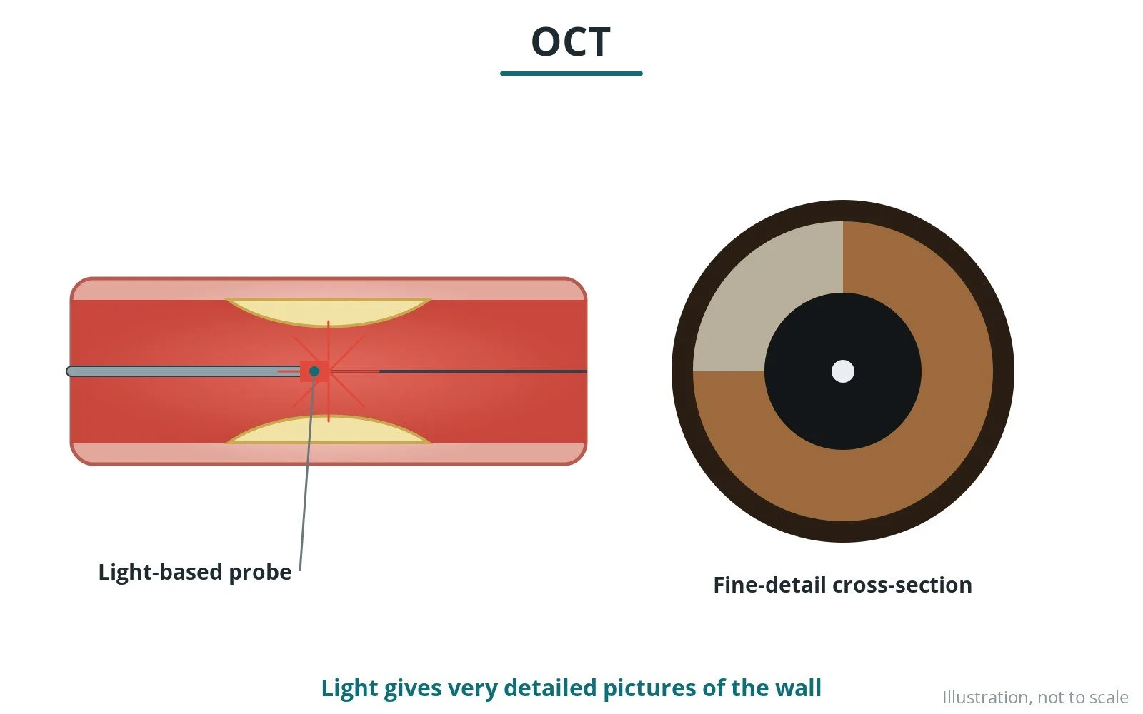 Optical coherence tomography (OCT): a Cath Lab 101 guide