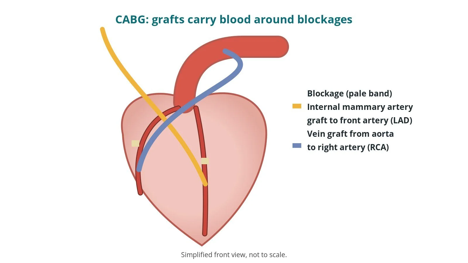 Coronary artery bypass grafting (CABG): an OR 101 guide