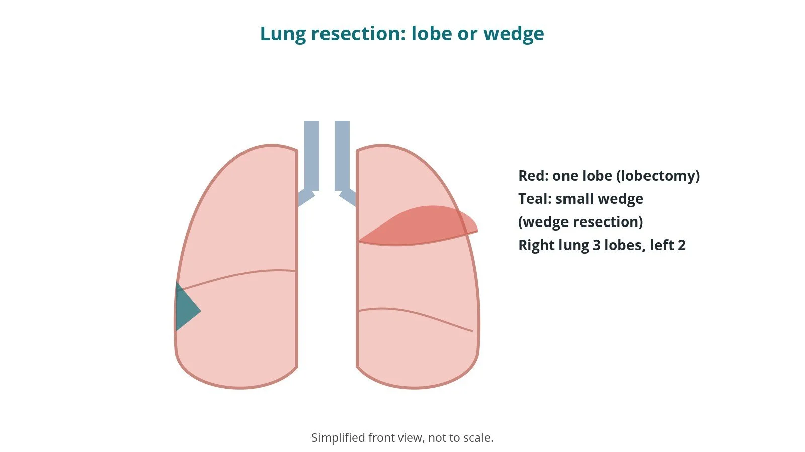Lobectomy and wedge resection: an OR 101 guide