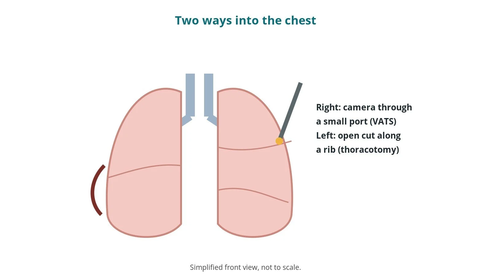 Thoracotomy and VATS: an OR 101 guide