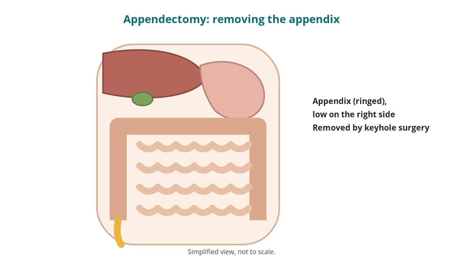 Laparoscopic appendectomy: an OR 101 guide