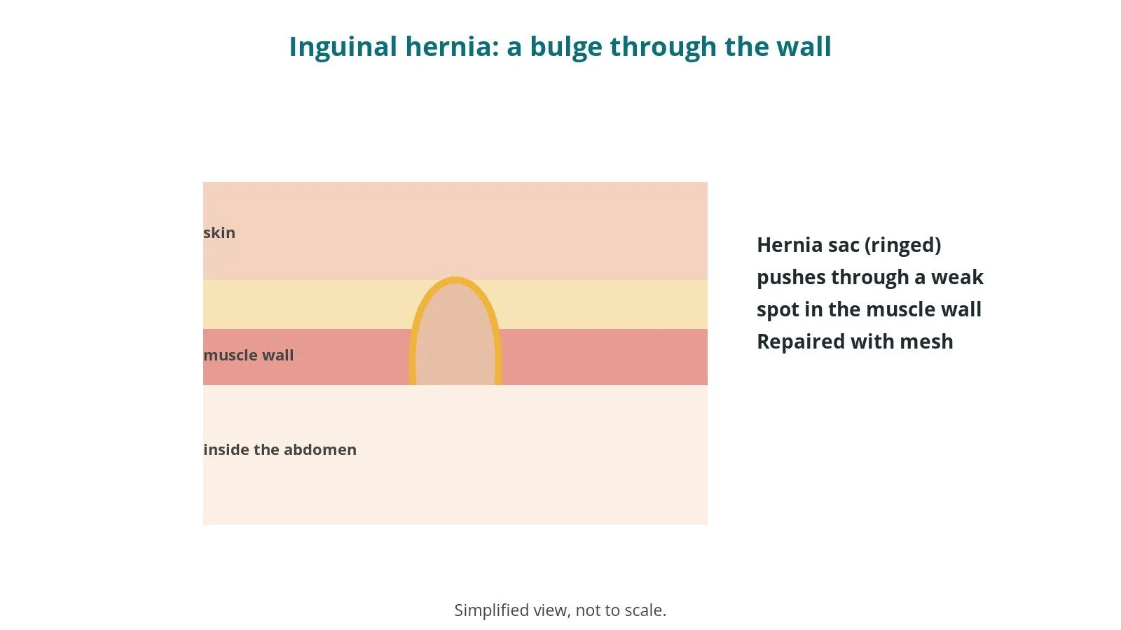 Inguinal hernia repair: an OR 101 guide