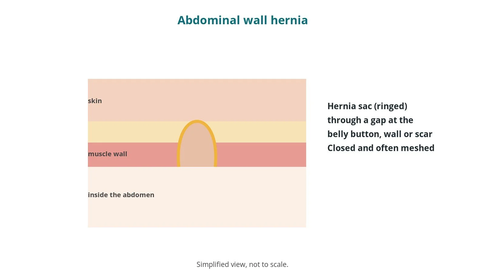 Umbilical, ventral and incisional hernia repair: an OR 101 guide