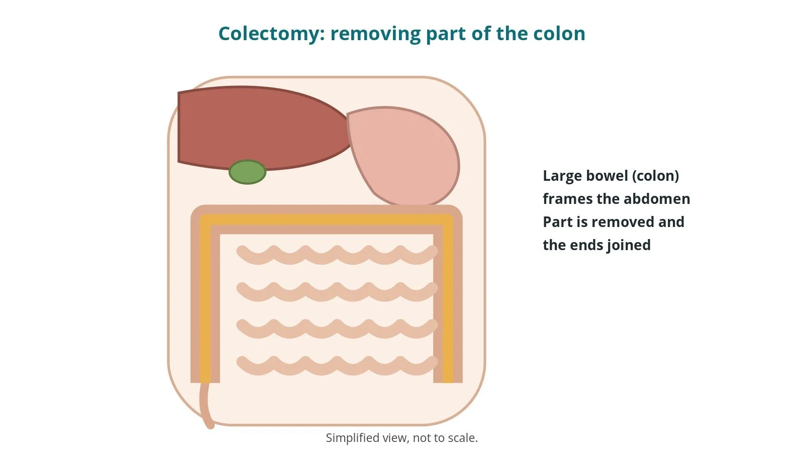 Colectomy (large bowel resection): an OR 101 guide