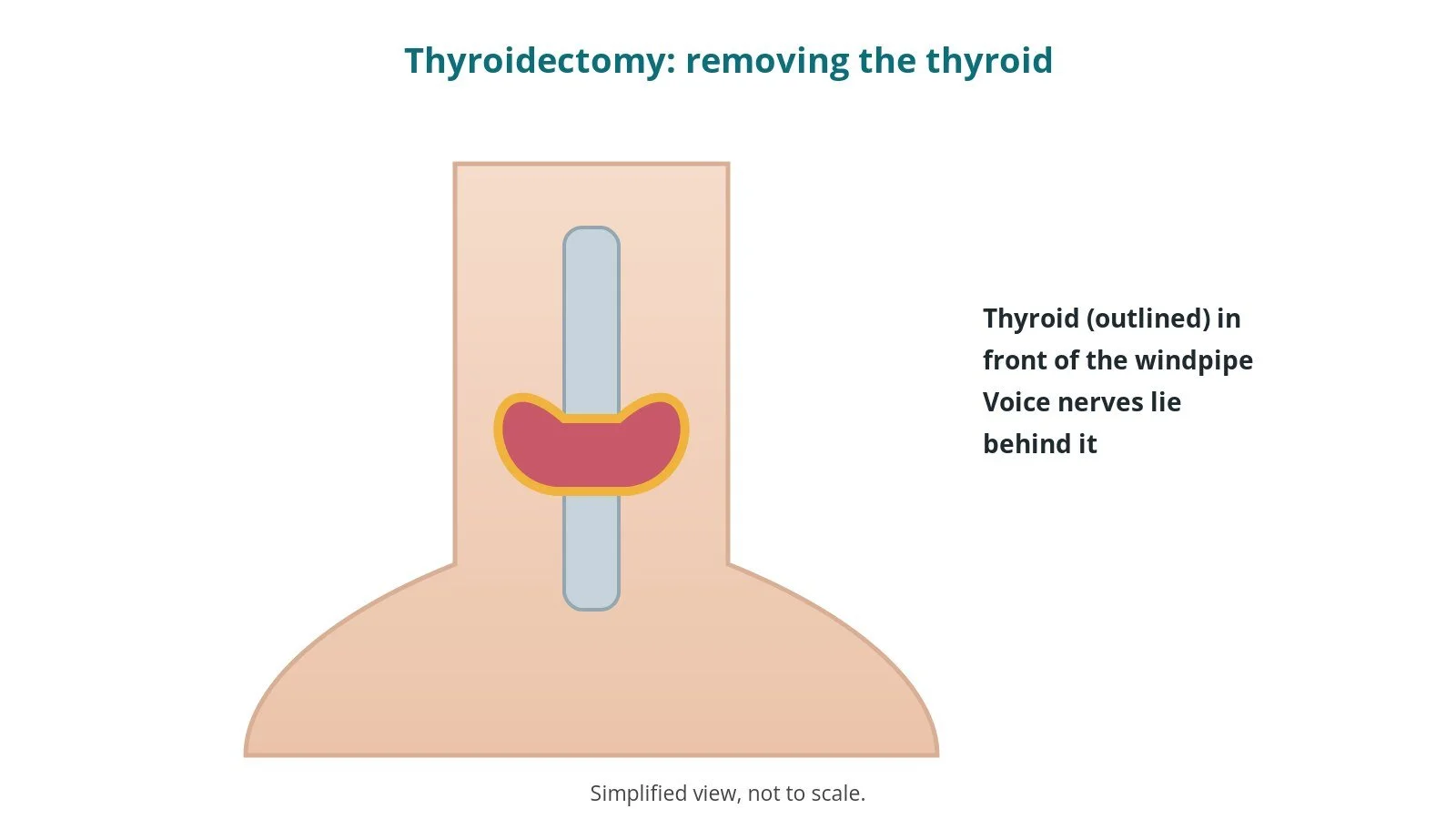 Thyroidectomy: an OR 101 guide