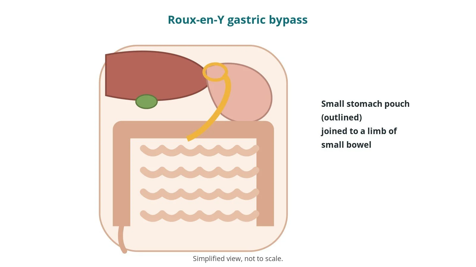 Roux-en-Y gastric bypass: an OR 101 guide