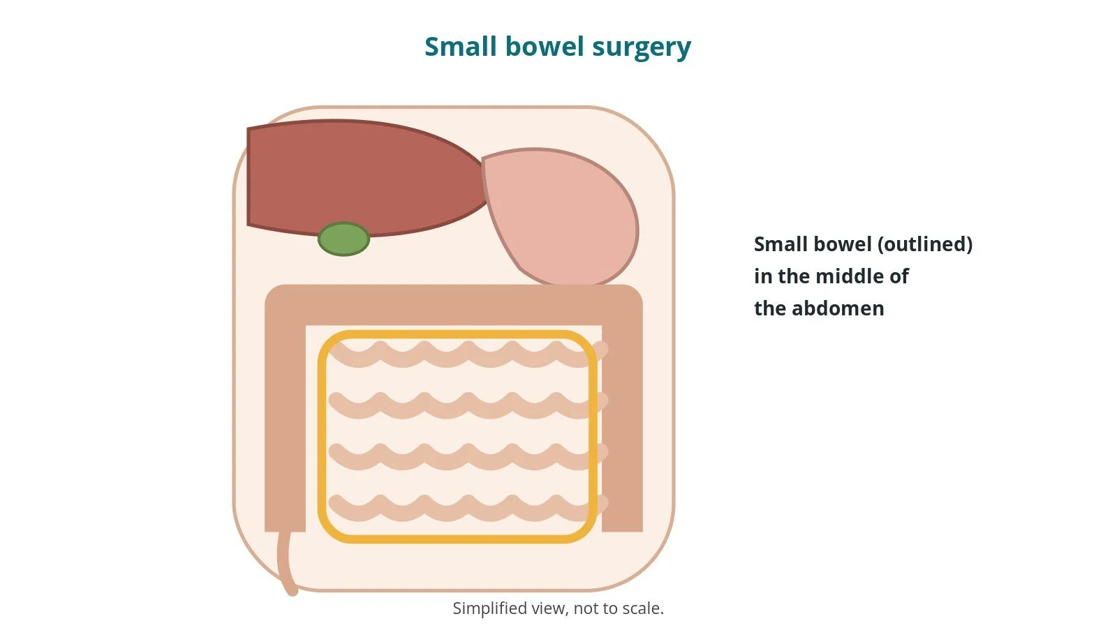 Small bowel resection and adhesiolysis: an OR 101 guide