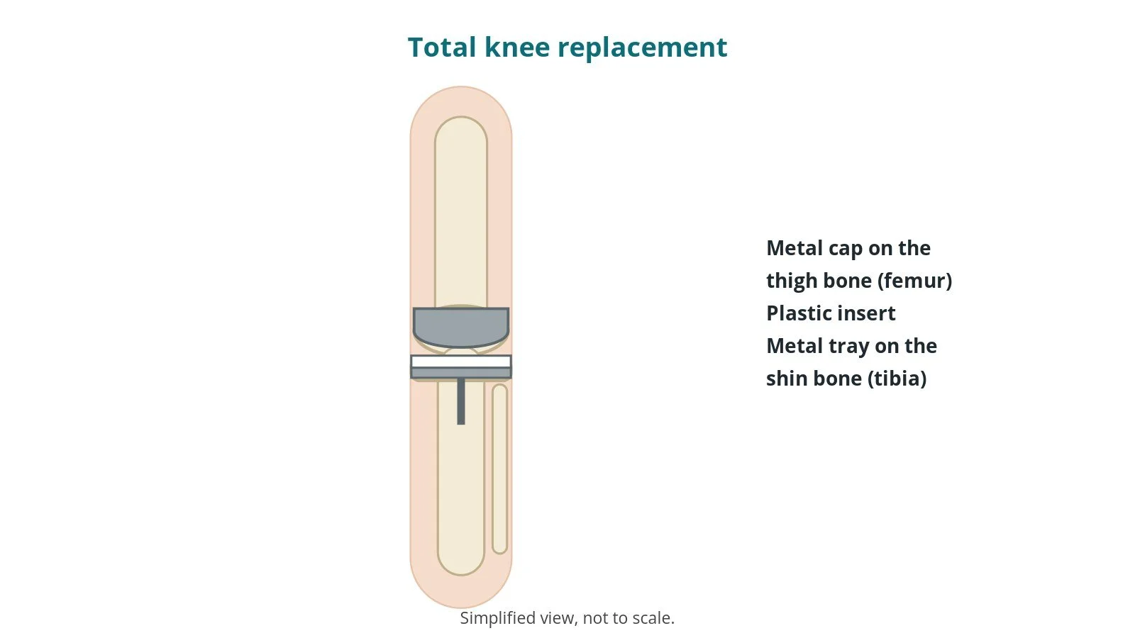 Total knee replacement (TKA): an OR 101 guide