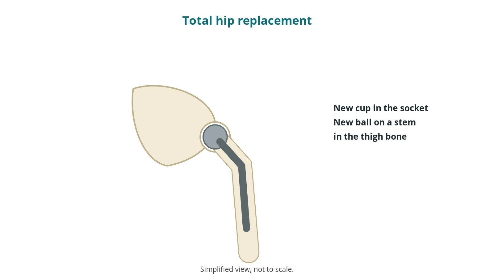 Total hip replacement (THA): an OR 101 guide