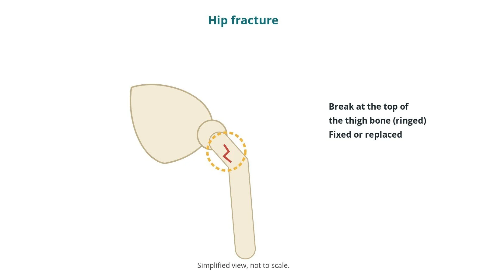 Hip fracture repair: an OR 101 guide