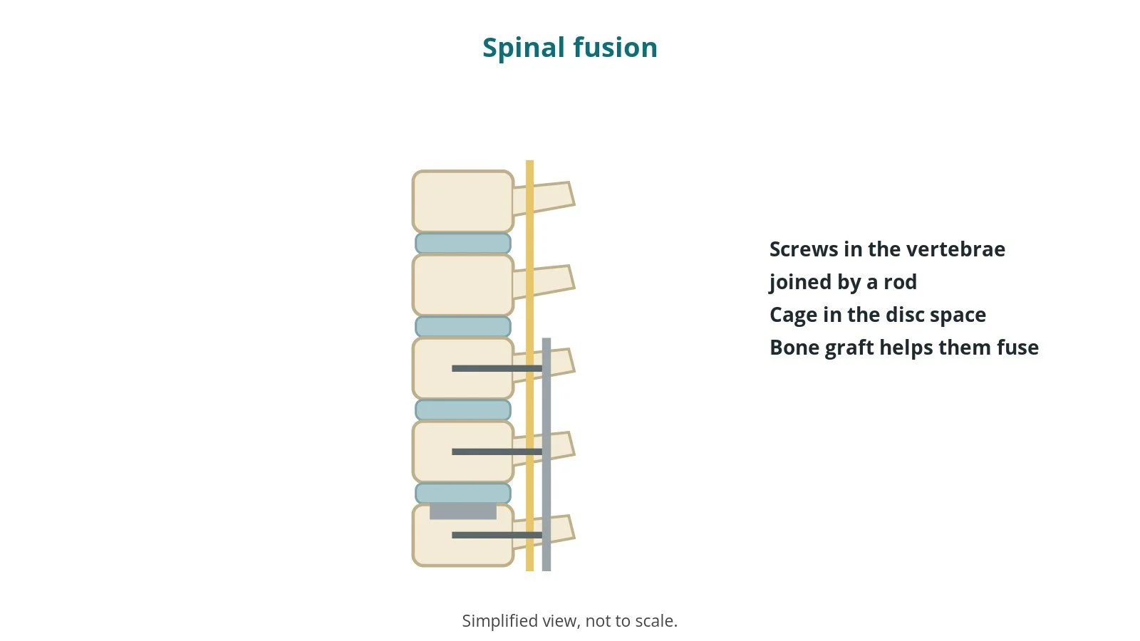 Spinal fusion: an OR 101 guide