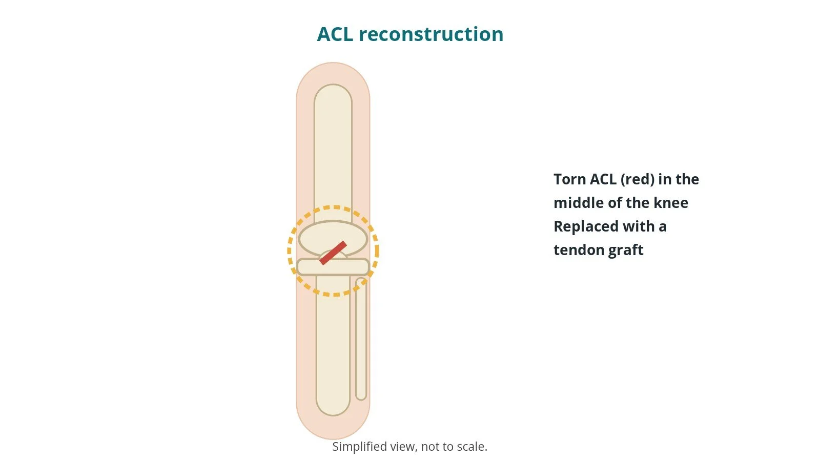 ACL reconstruction: an OR 101 guide