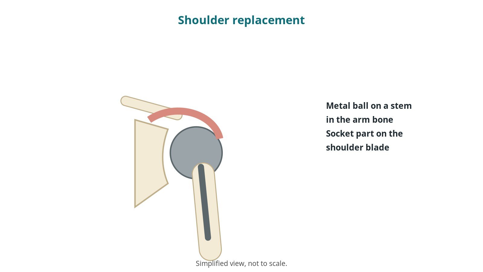 Shoulder replacement (arthroplasty): an OR 101 guide