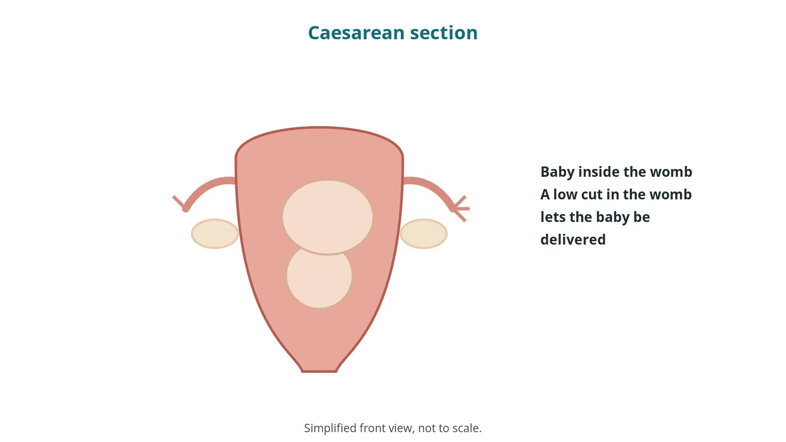 Caesarean section (C-section): an OR 101 guide