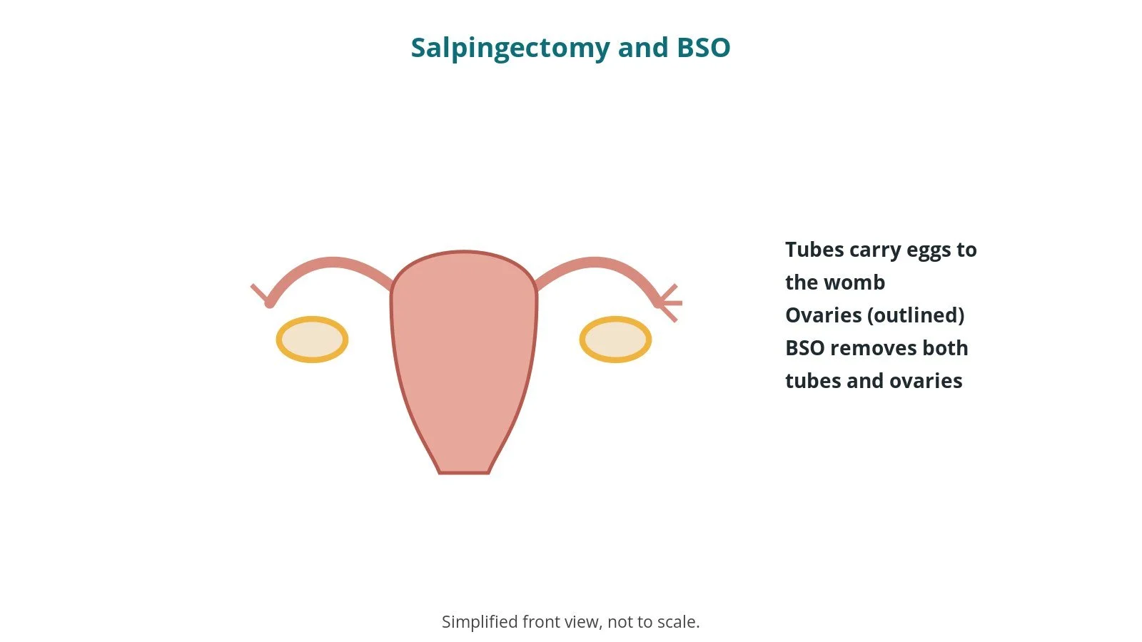 Salpingectomy and BSO: an OR 101 guide
