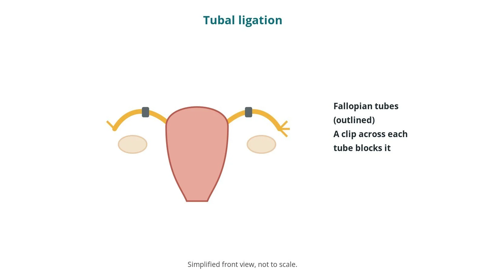 Tubal ligation (female sterilisation): an OR 101 guide