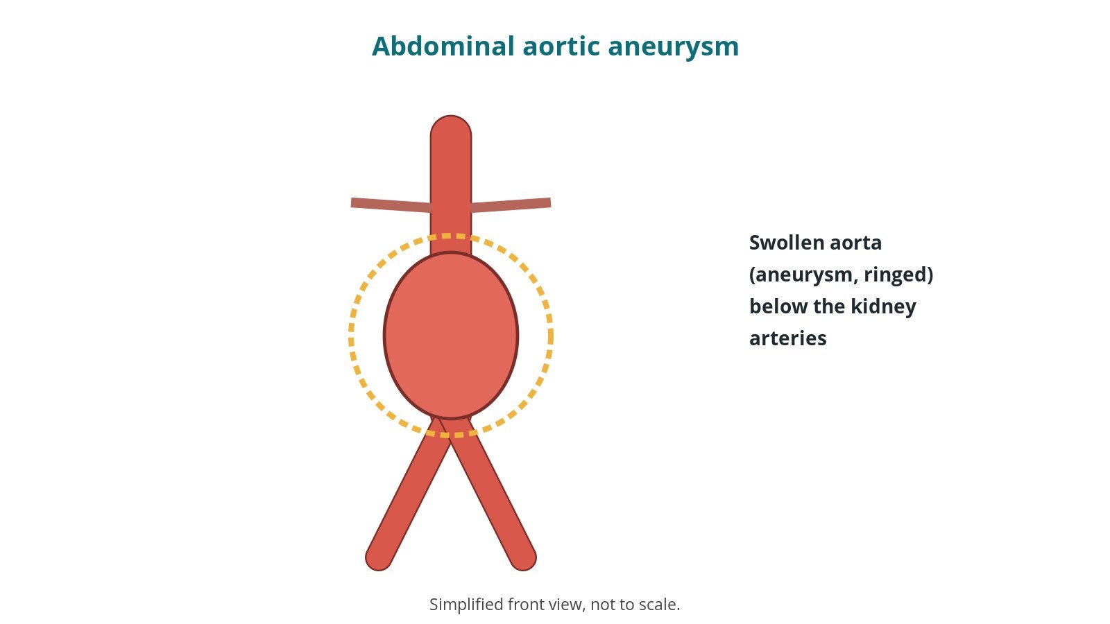 Open abdominal aortic aneurysm (AAA) repair: an OR 101 guide