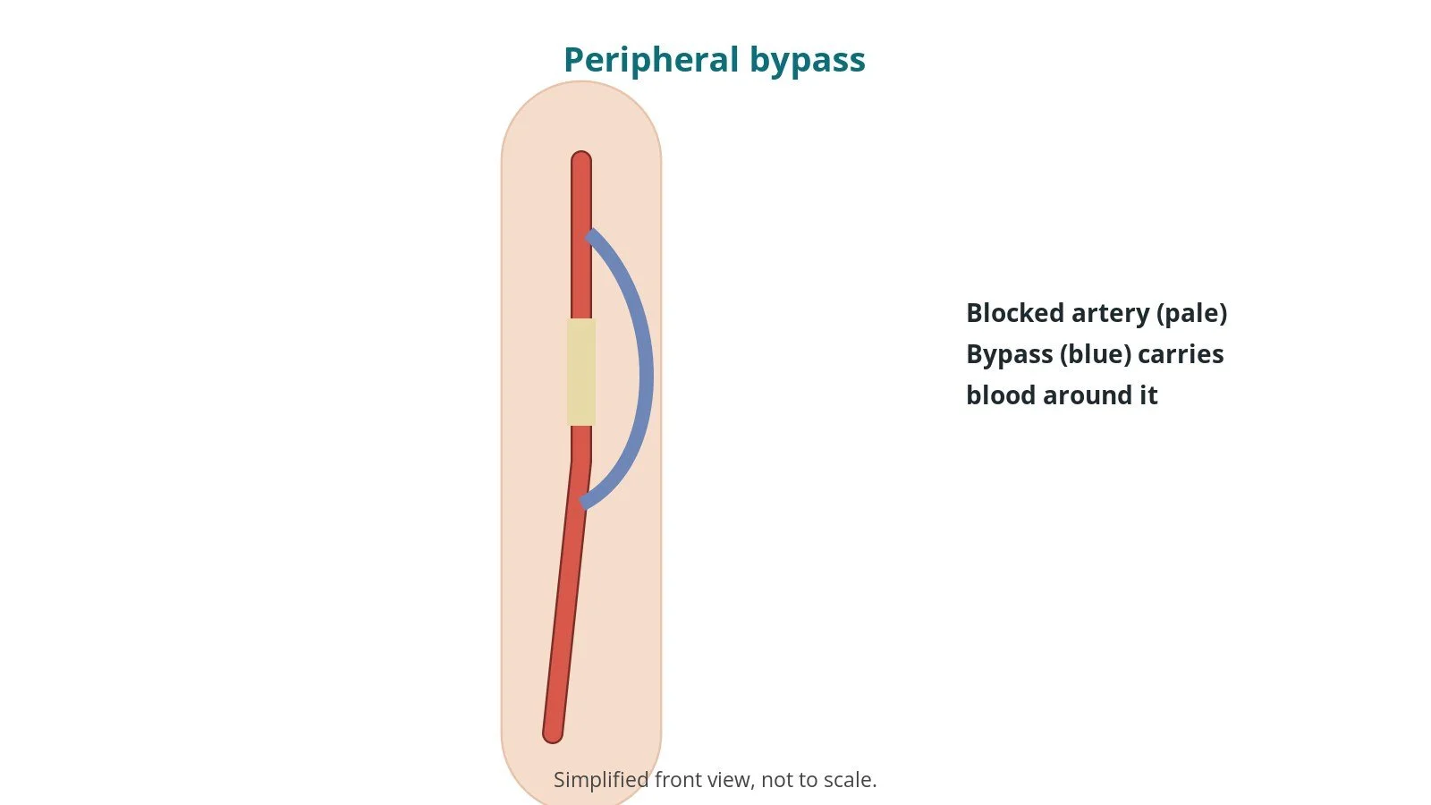 Peripheral bypass surgery: an OR 101 guide